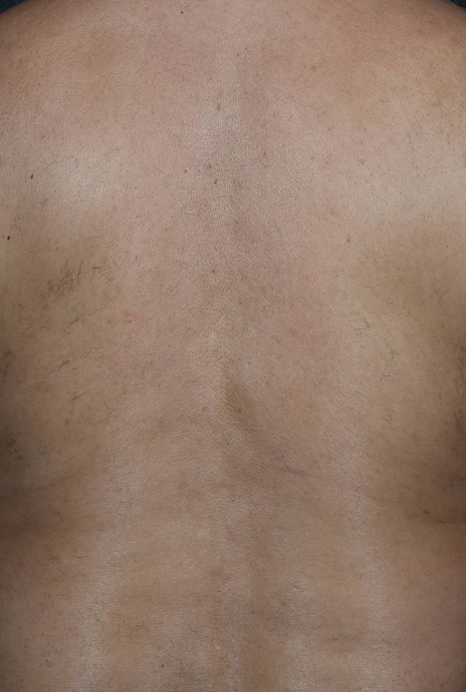 Laser Hair Removal  Before & After Image