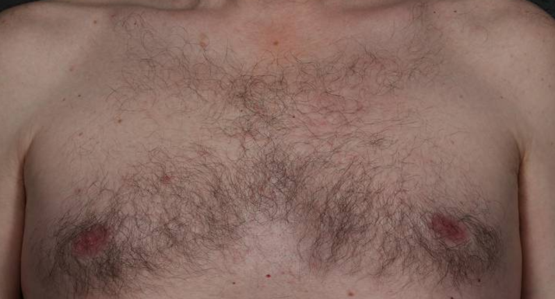 Laser Hair Removal  Before & After Image