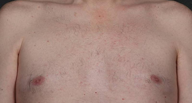 Laser Hair Removal  Before & After Image