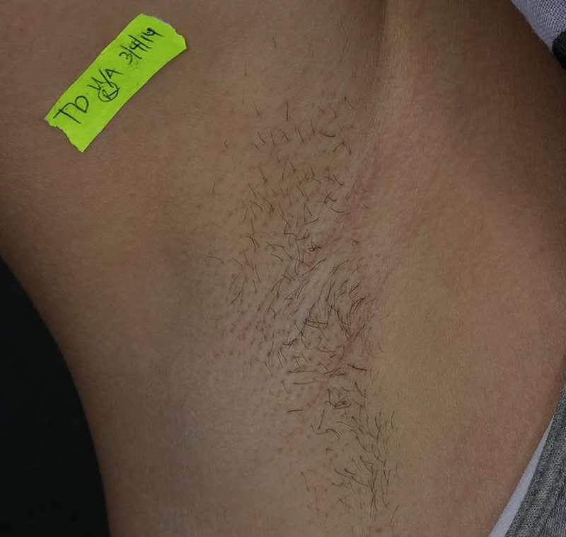 Laser Hair Removal  Before & After Image