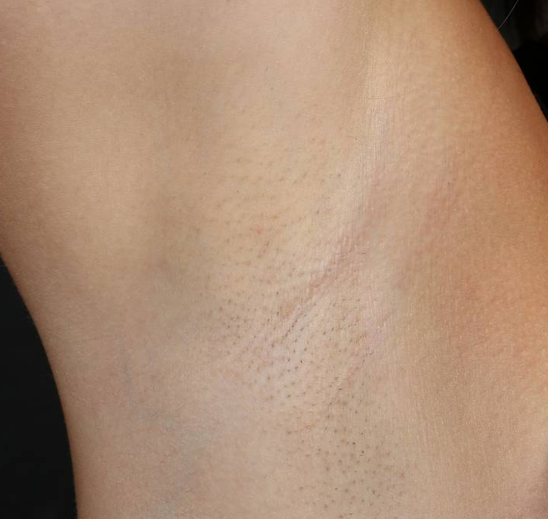 Laser Hair Removal  Before & After Image