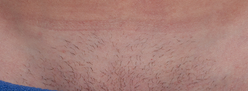 Laser Hair Removal  Before & After Image