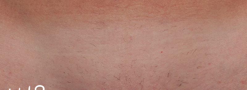 Laser Hair Removal  Before & After Image