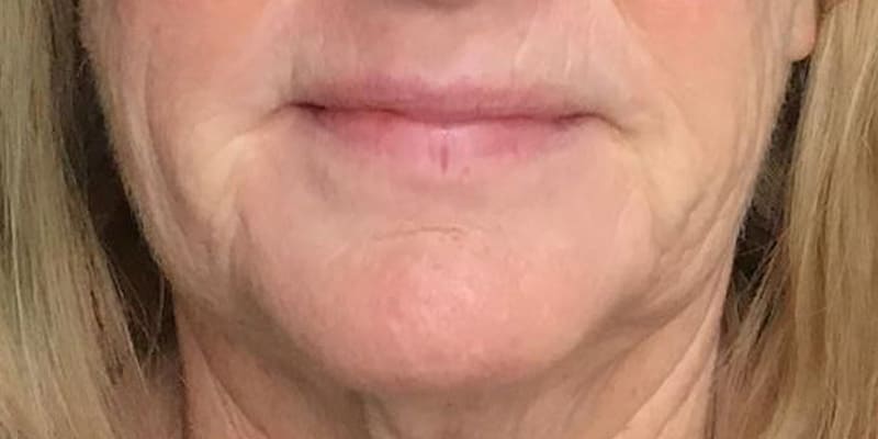 RF Microneedling Before & After Image
