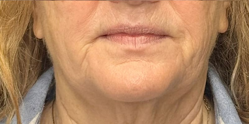 RF Microneedling Before & After Image