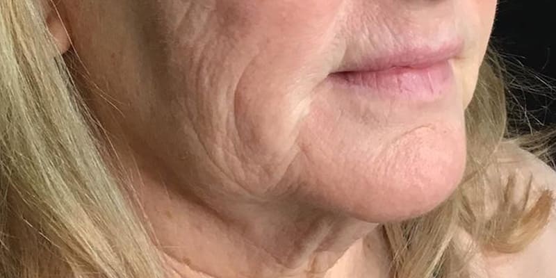 RF Microneedling Before & After Image