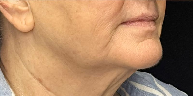 RF Microneedling Before & After Image