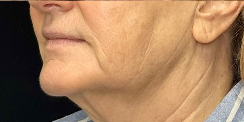 RF Microneedling Before & After Image