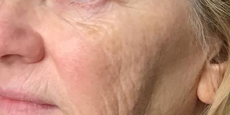 RF Microneedling Before & After Image