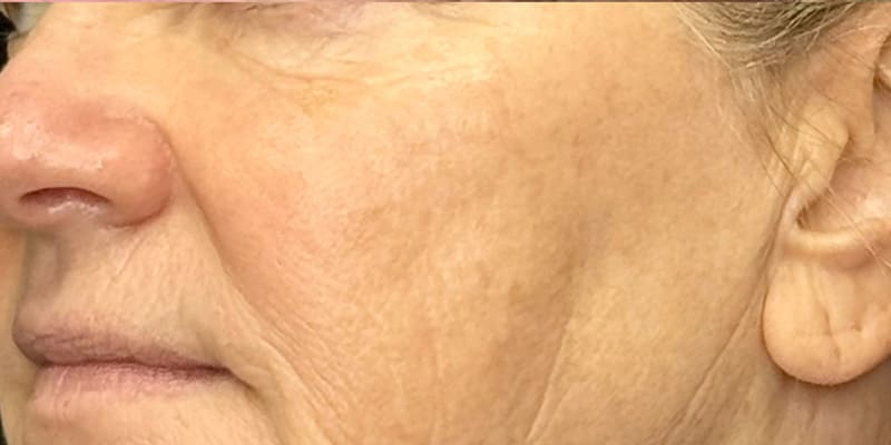 RF Microneedling Before & After Image