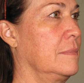 Ultherapy Before & After Image