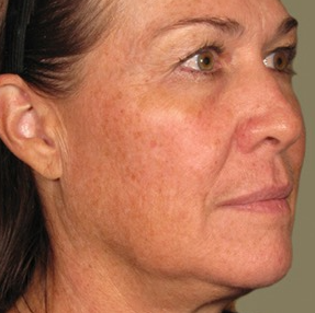 Ultherapy Before & After Image