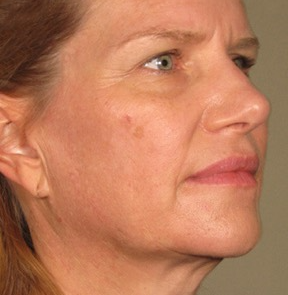 Ultherapy Before & After Image