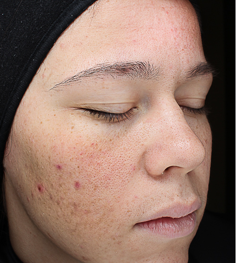 Chemical Peels Before & After Image
