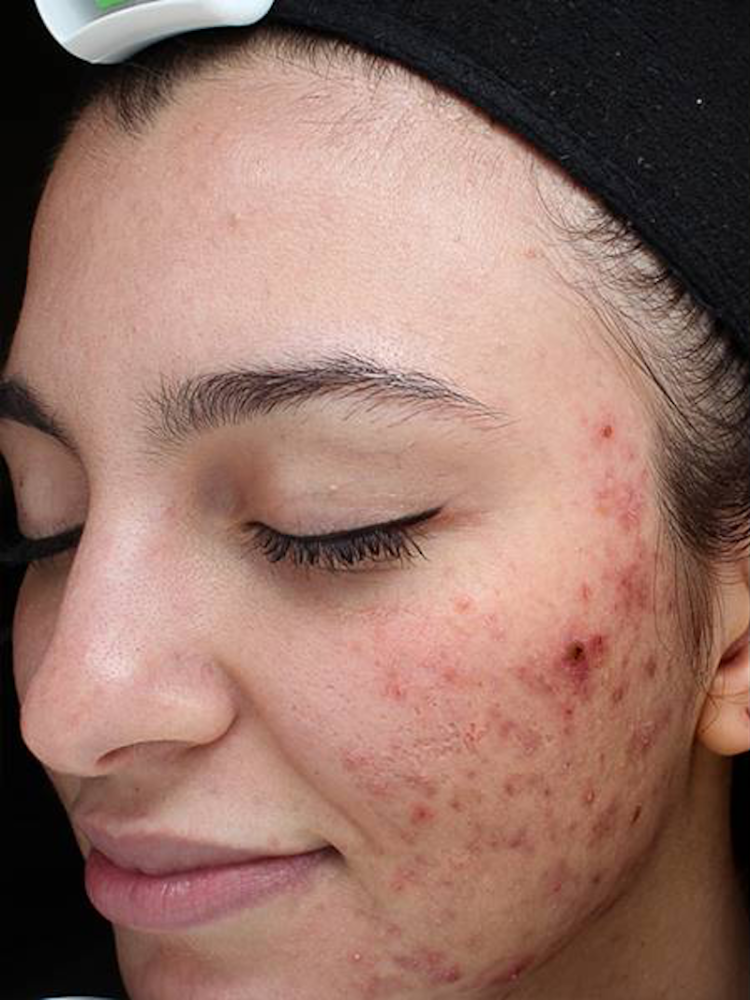 Chemical Peels Before & After Image