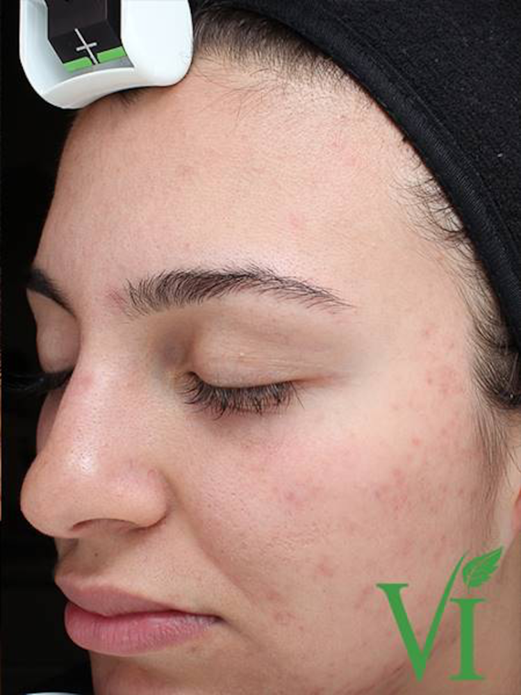 Chemical Peels Before & After Image