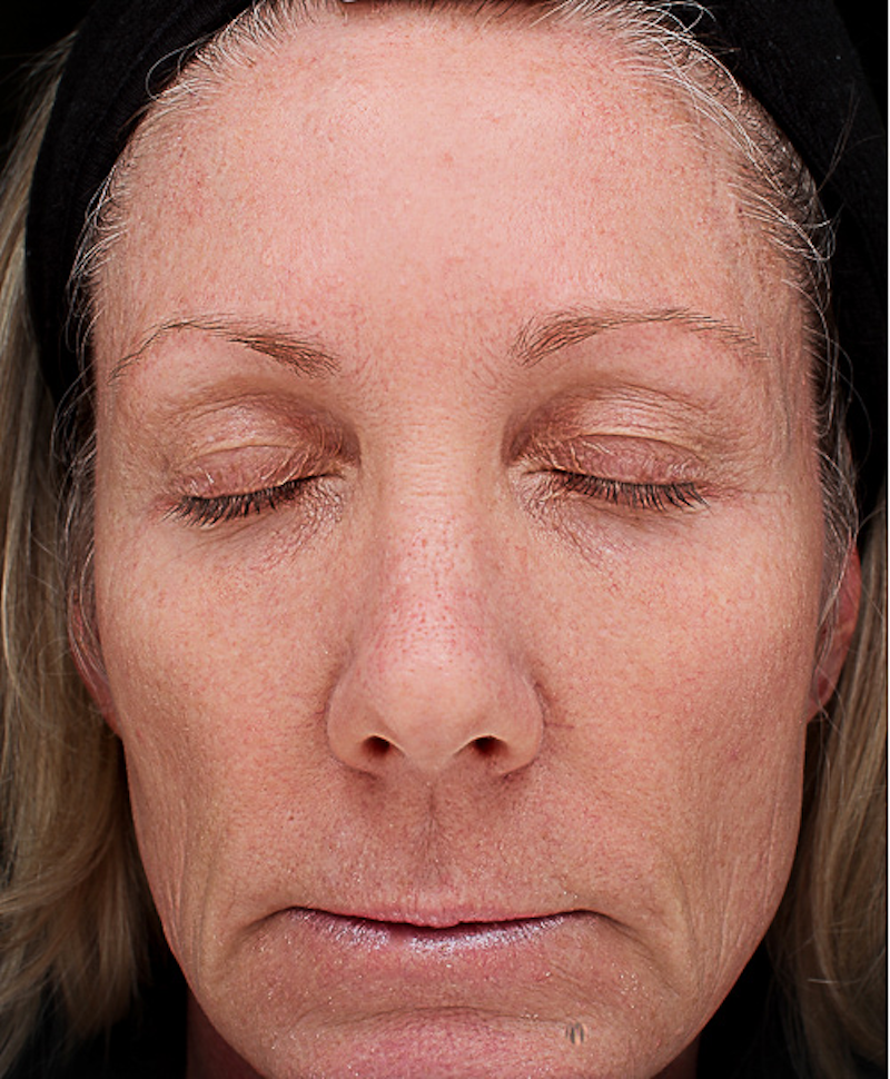 Chemical Peels Before & After Image