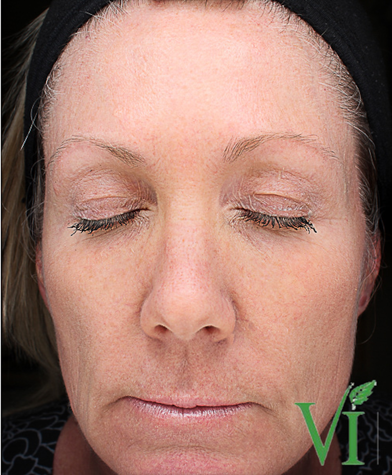 Chemical Peels Before & After Image