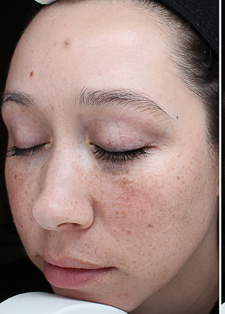 Chemical Peels Before & After Image