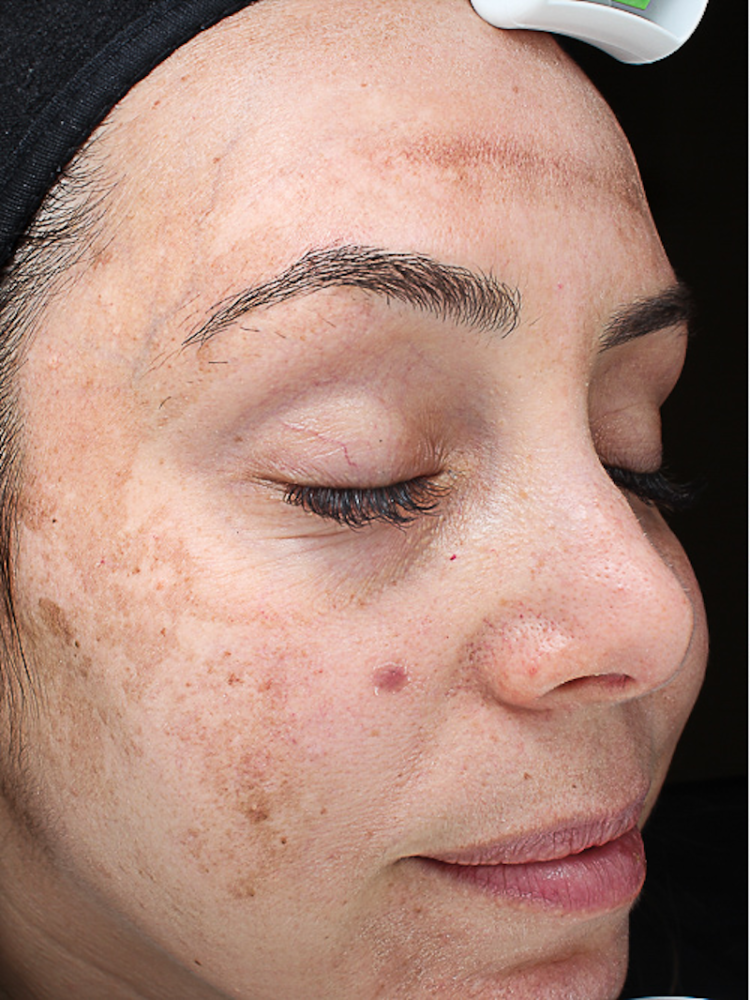 Chemical Peels Before & After Image