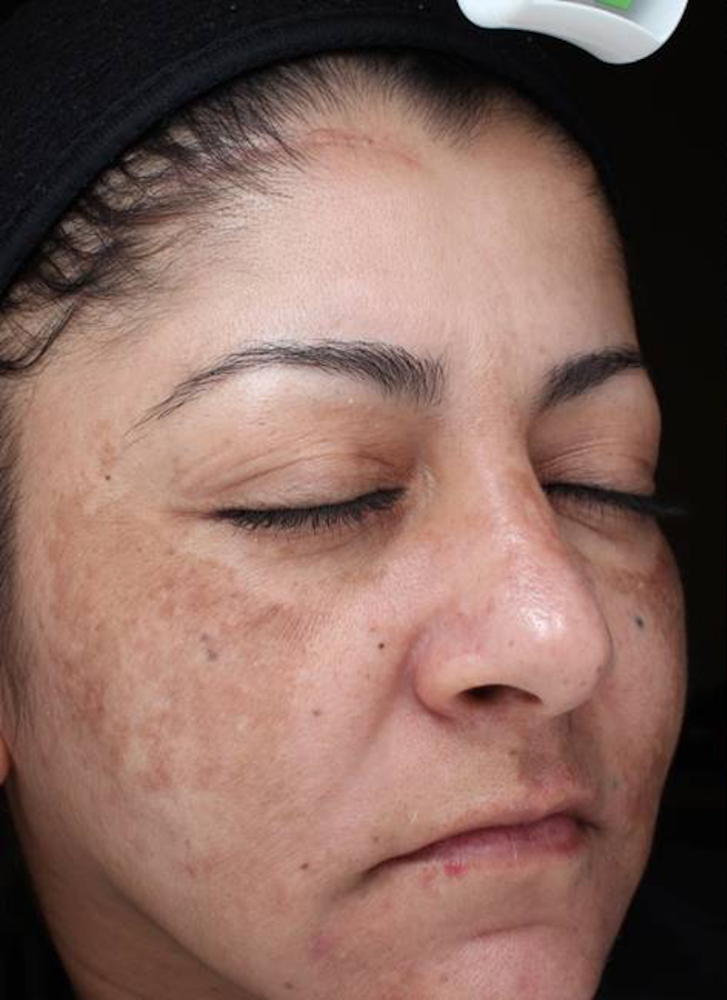 Chemical Peels Before & After Image