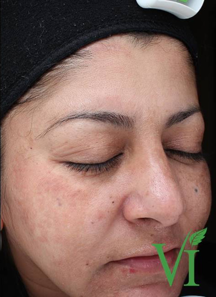 Chemical Peels Before & After Image