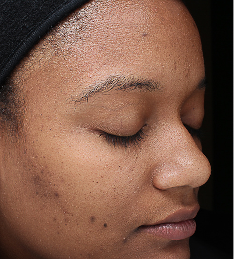 Chemical Peels Before & After Image