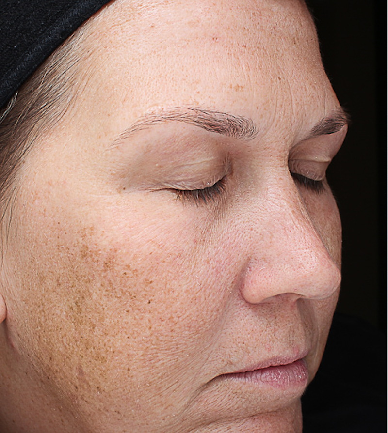 Chemical Peels Before & After Image