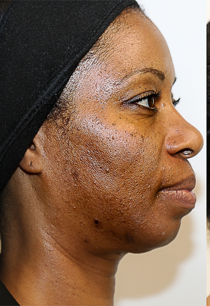 Chemical Peels Before & After Image