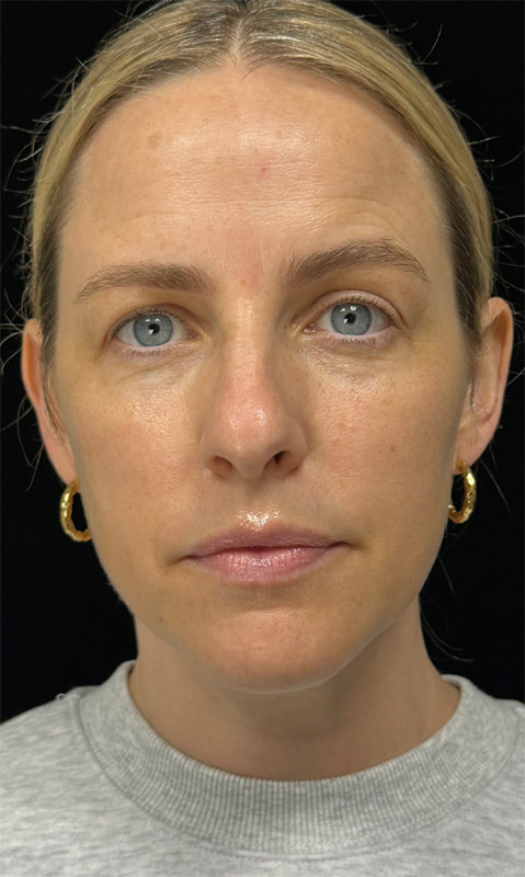 Chemical Peels Before & After Image