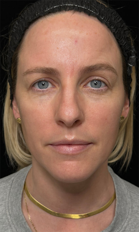 Chemical Peels Before & After Image