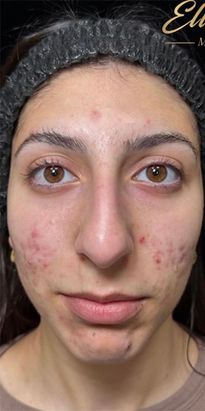 Facials Before & After Image