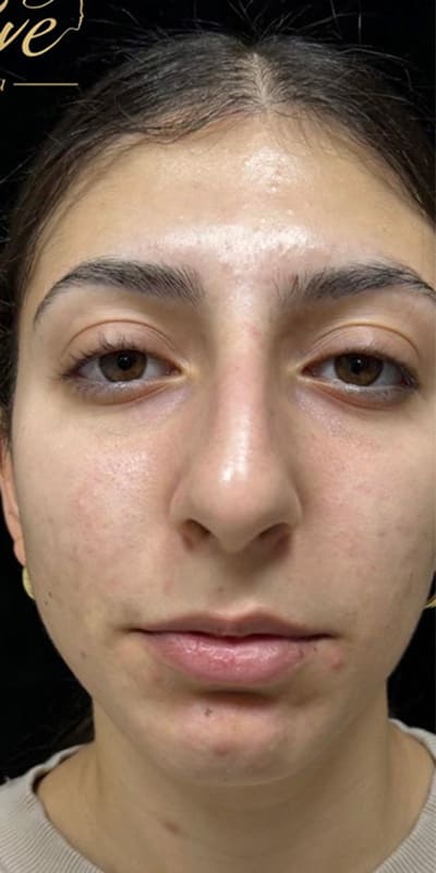 Facials Before & After Image
