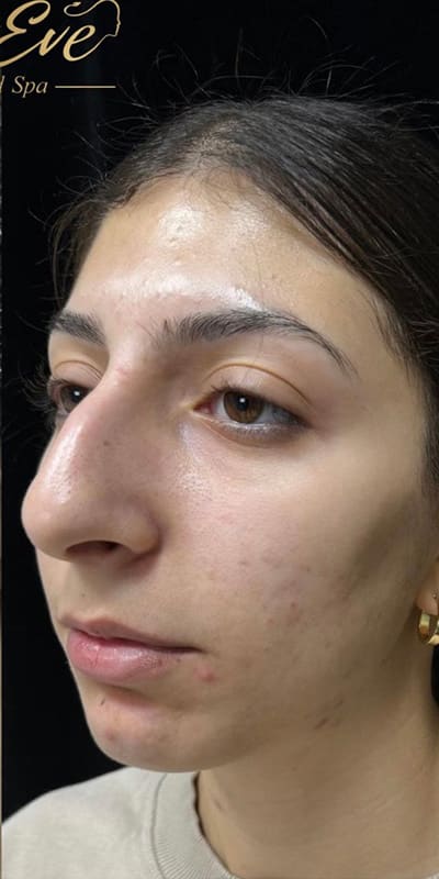 Facials Before & After Image