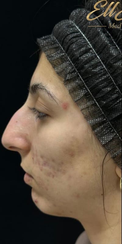 Facials Before & After Image