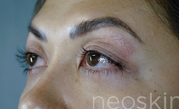 NeoSkin Plasma Pen Before & After Image