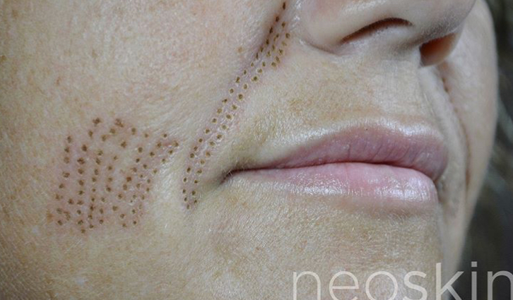 NeoSkin Plasma Pen Before & After Image