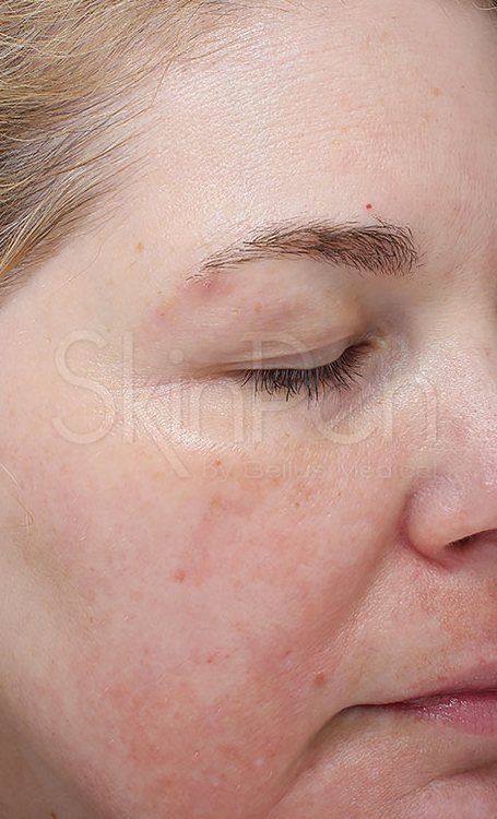 Microneedling Before & After Image