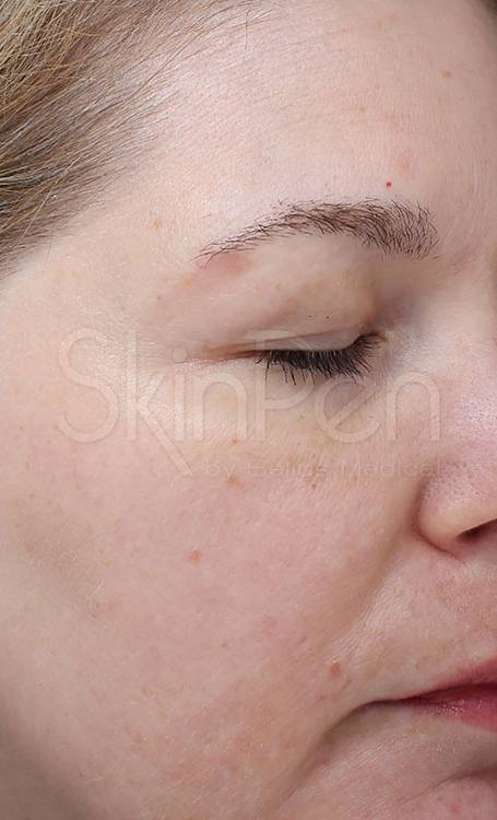 Microneedling Before & After Image