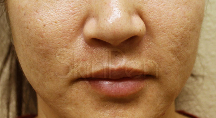 Microneedling Before & After Image