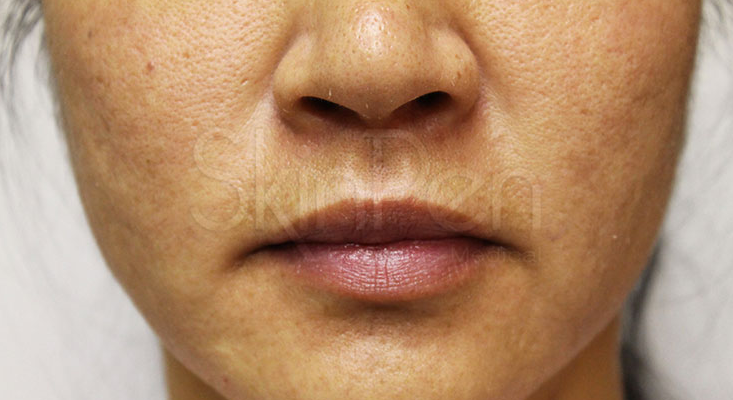 Microneedling Before & After Image