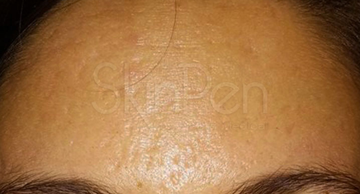 Microneedling Before & After Image