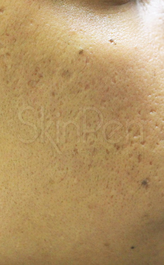 Microneedling Before & After Image