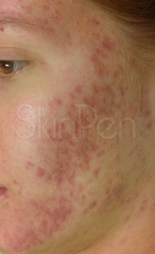 Microneedling Before & After Image