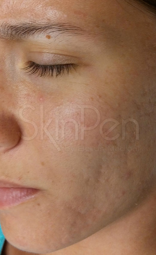 Microneedling Before & After Image