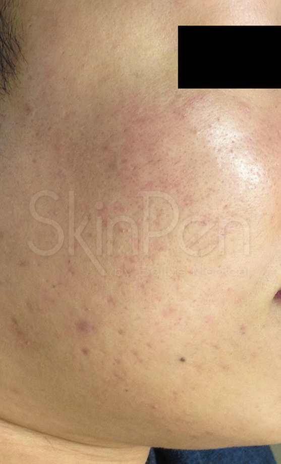 Microneedling Before & After Image