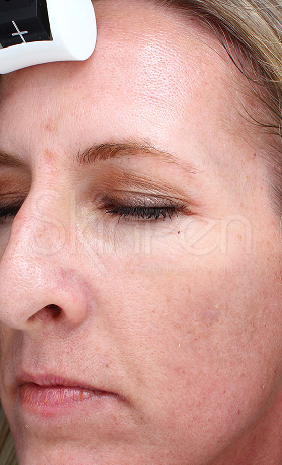 Microneedling Before & After Image