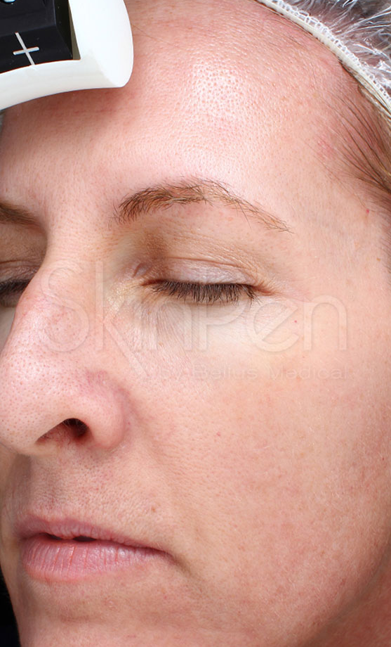 Microneedling Before & After Image