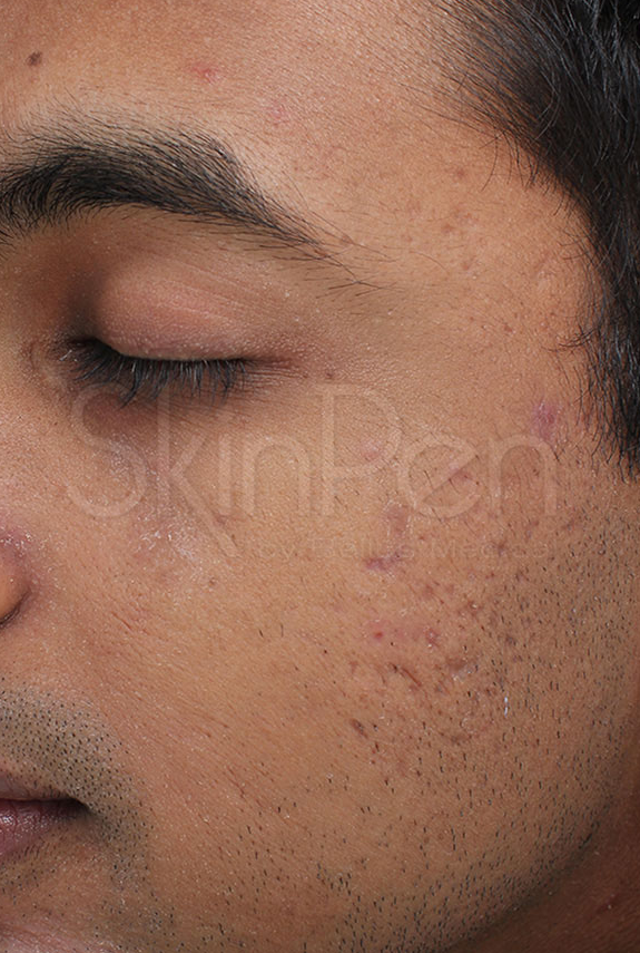 Microneedling Before & After Image