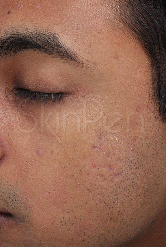 Microneedling Before & After Image